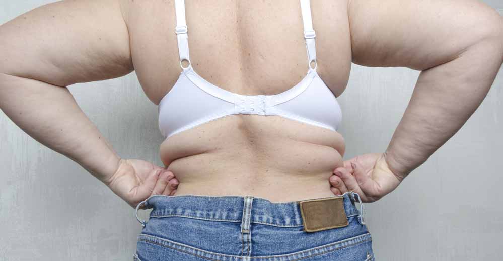 backlift liposuction