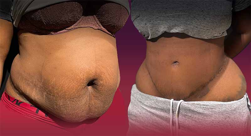 extended tummy tuck 6 months post op