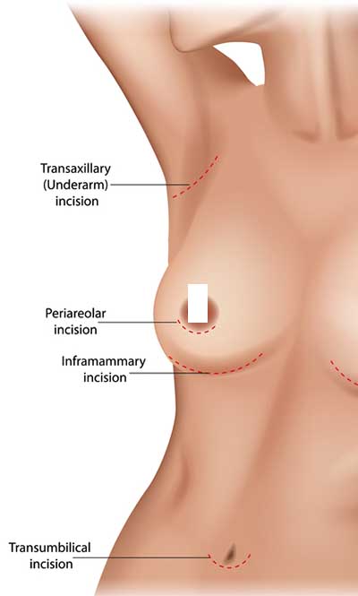 Breast Augmentation Incision Placement. Incision points in breast implant surgery. Transumbilical, Inframammary, Periareolar and Transaxillary incision.