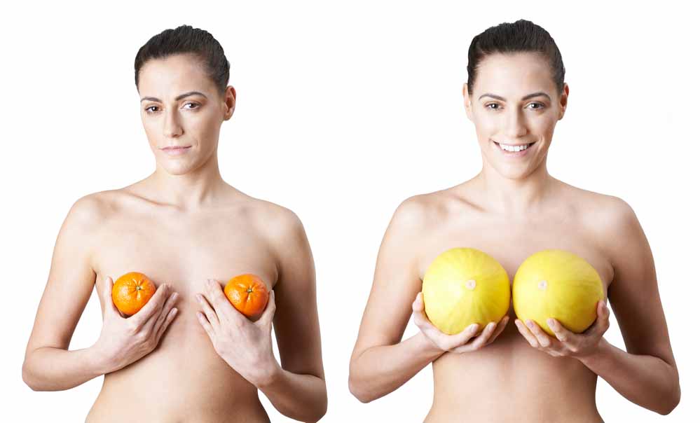 breast augmentation