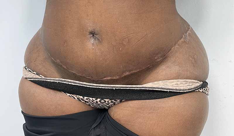 extended tummy tuck scar