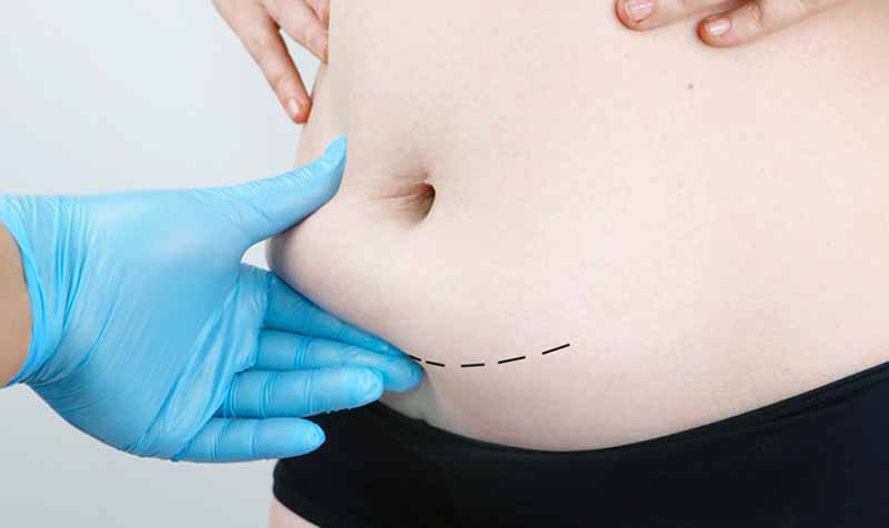 mini tummy tuck