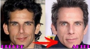 ben stiler ear surgery