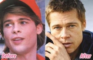 brad pitt ear surgery