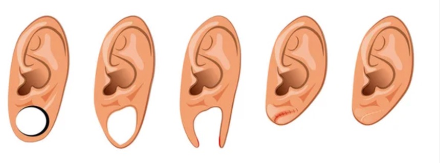ear lobe reconstruction 