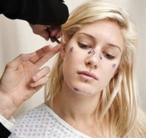 heidi montag ear surgery